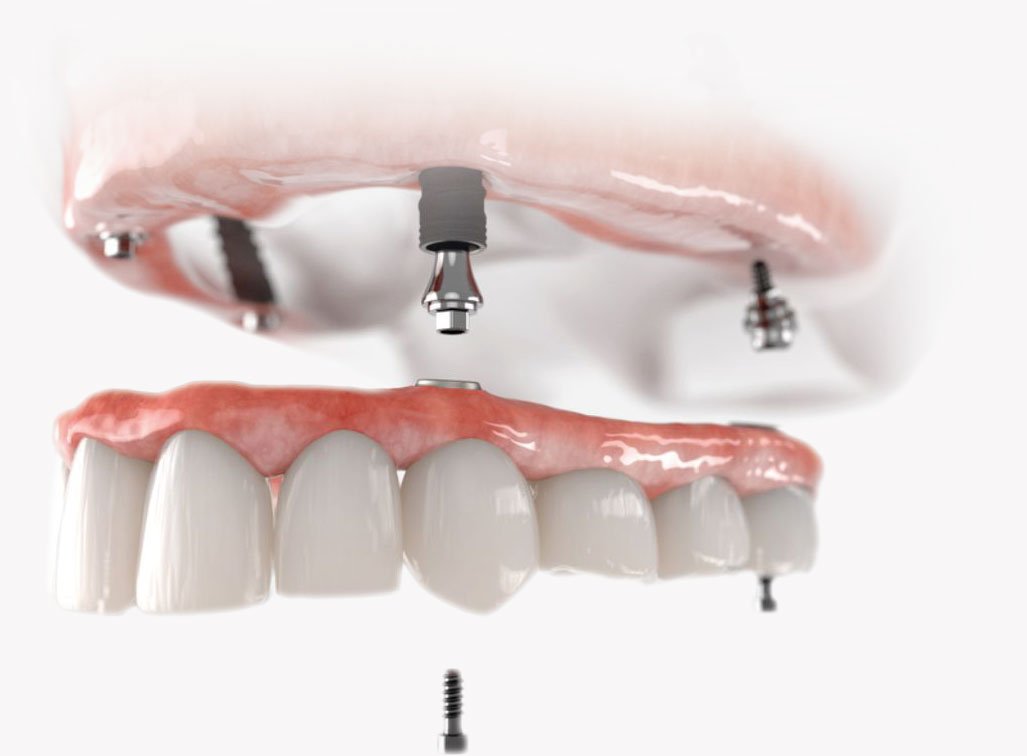 Prótese protocolo All-on-4 — implantes dentários em Mogi das Cruzes