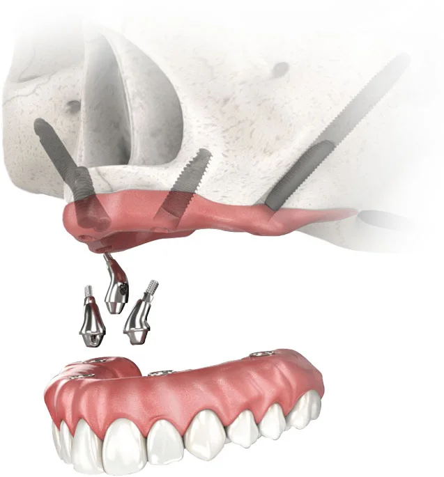 Uma ilustração 3D dos Implantes Zigomáticos